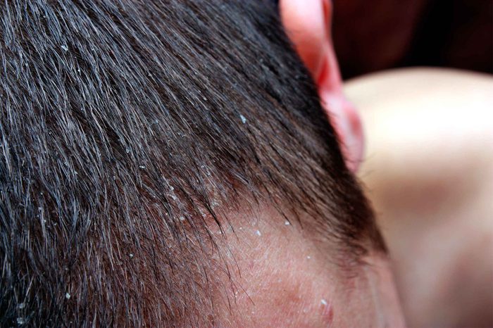 Boy's hair with dandruff. 