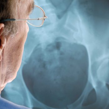 10_signs_not_getting_enough_magnesium_bone_loss_Chris-Fertnig
