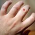 12 Home Remedies for Warts You Can Actually Make Right at Home