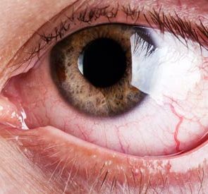 02_Allergies_Reasons_You_have_bloodshot_eyes