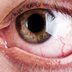 9 Reasons You Have Bloodshot Eyesâ€”and How to Fix Them