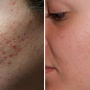 The-5-Types-of-Acne-Scars-and-How-to-Treat-Them-FT