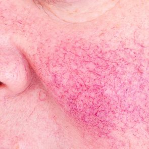 rosacea