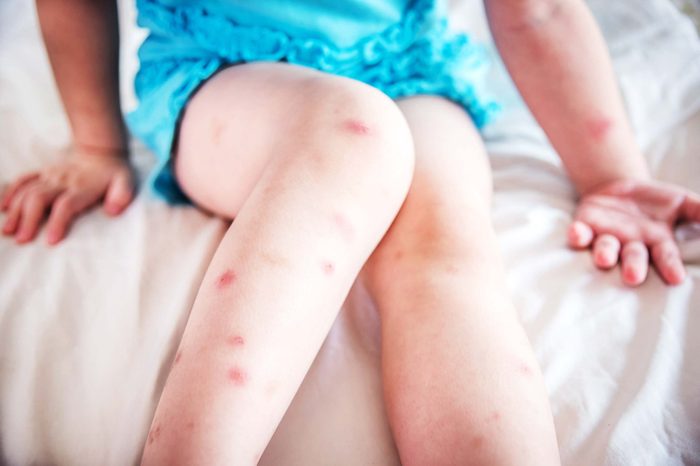 bed bug mosquito bites