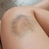 The Doctor-Approved Way to Get Rid of Bruises ASAP