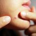 Why You Get Chin Acneâ€”and How to Clear It Up