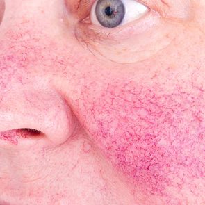 rosacea
