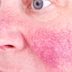Yes, Windy Weather Can Trigger Rosaceaâ€”and So Can These 6 Other Things