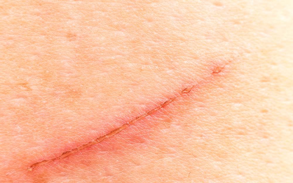 The Secret to Preventing Scars Is This One Ingredient (Hint: It’s Not Neosporin!)