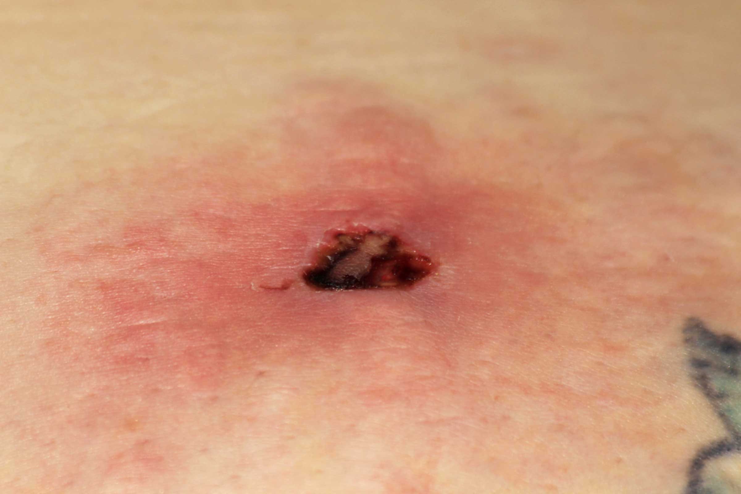 how to identify brown recluse spider bites on human skin