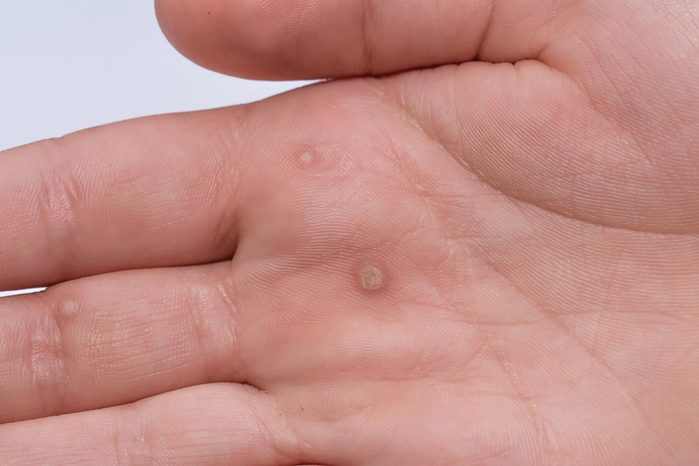close up of a wart on the palm of the hand