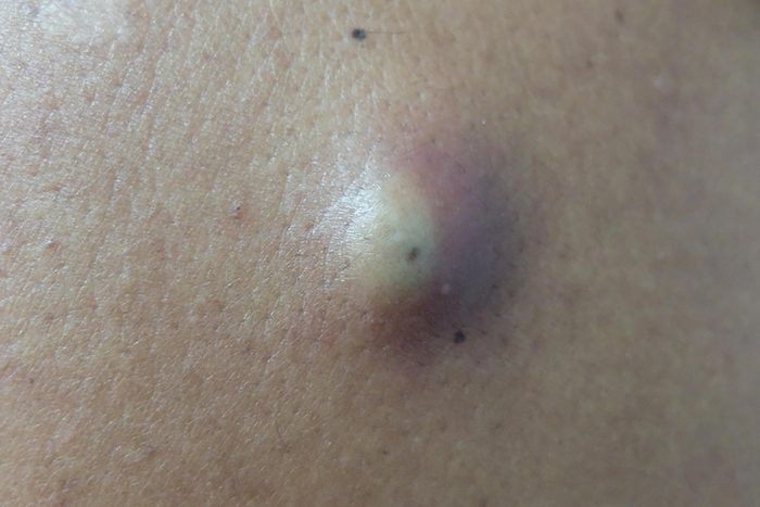 close up of a cyst