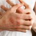 10 Types of Poison Ivy Treatment Youâ€™ll Be Thankful to Know