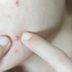 This Is the Easiest Way to Get Rid of a Pimple, According to a Dermatologist