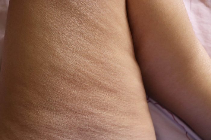 Rippled cellulite on thigh