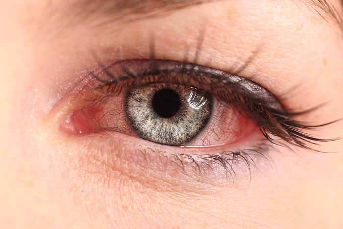 woman pink eye