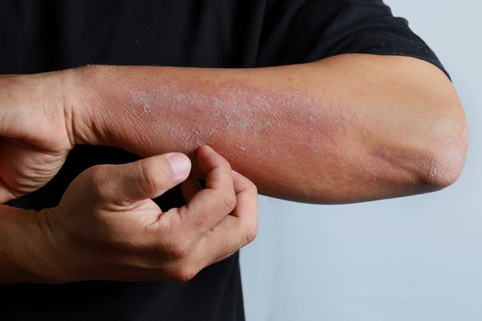 Man scratching an allergic rash on the skin of his arm.