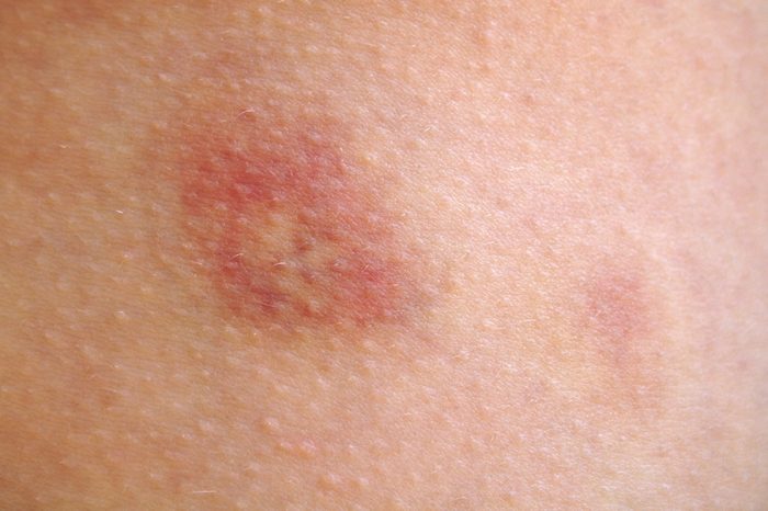A skin welt