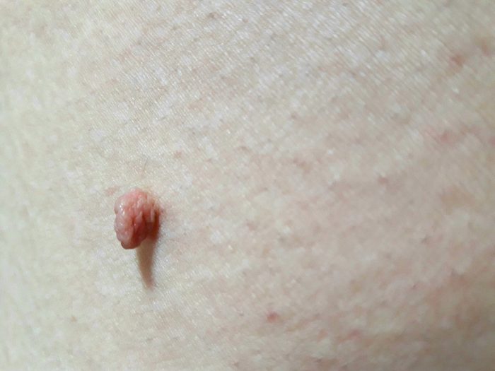 Acrochordon -- a skin tag