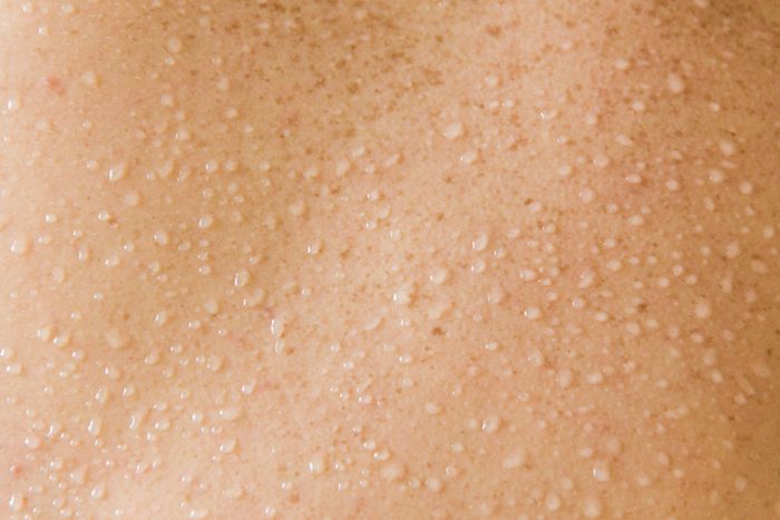 Beads of sweat are forming on the back. Disposition to sweating or perspiring.