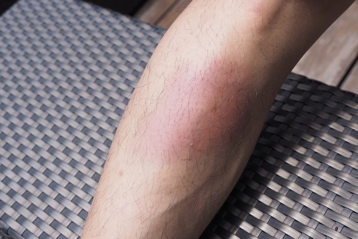 close up of a big lower leg bruise