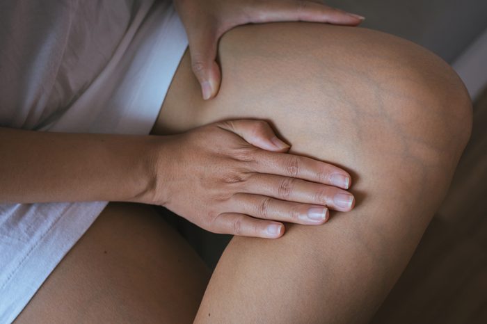 Visible veins on a woman's leg