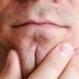 This Is How to Treat Every Type of Acne