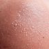 Sun Blister: Here's How to Tell If You Have One, and How to Treat It