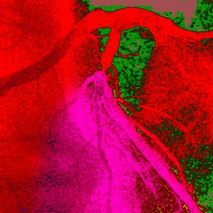 Myocardial Infarction, Angiography
