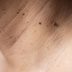 How to Get Rid of Skin Tags the Right Way, According to Expert Dermatologists